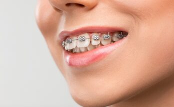 Tout ce qu'il faut savoir sur l'orthodontie