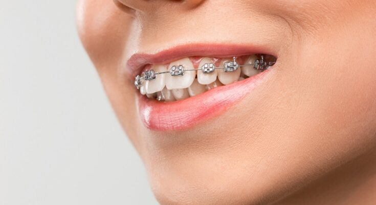 Tout ce qu'il faut savoir sur l'orthodontie